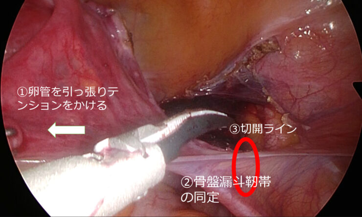 骨盤漏斗靭帯の処理② 手技のコツ4選✙白色凝固って? のアイキャッチ