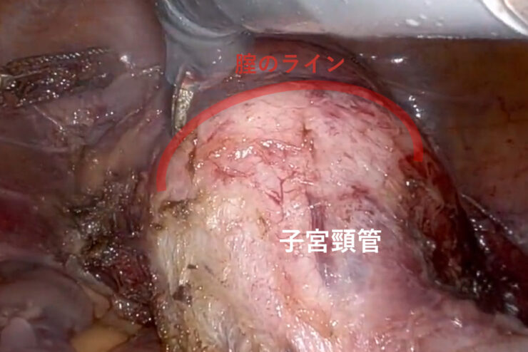 腟管切開①　もうミスらない腟管切開「たった一つのうまくいく基準は”とあるイメージ”」 のアイキャッチ